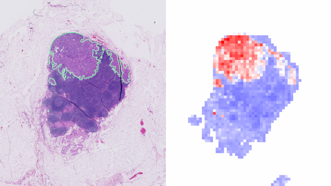 The picture is divided into two parts: On the left, a tissue section with cells, on which an area is marked with a green line. On the right, the same tissue section in a pixelated version on which an algorithm has marked a similar area in red.